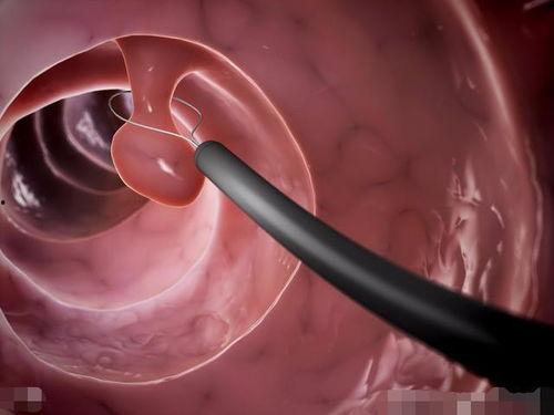 肠镜前可吃哈密瓜吗视频,哈密瓜可否食用揭秘